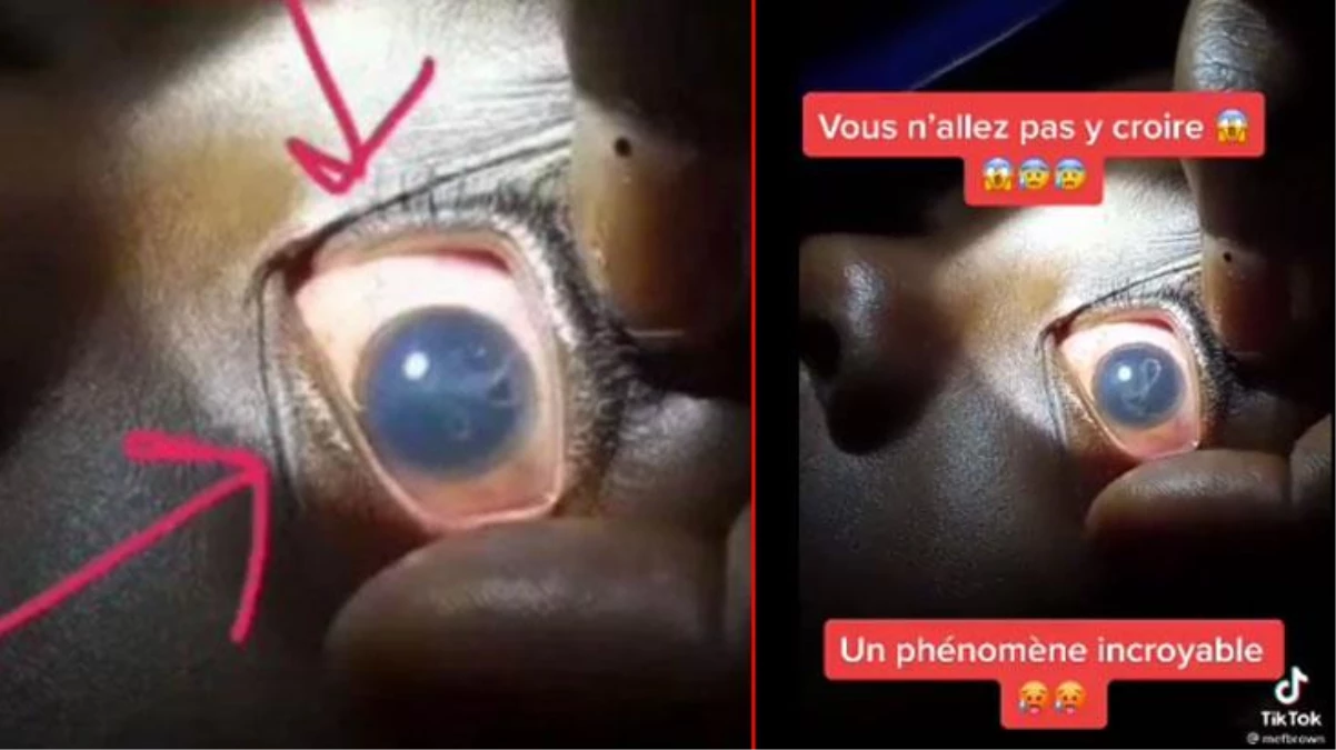 Koronavirüs aşısı olan bir kişinin gözünde solucan oluştuğu iddiası
