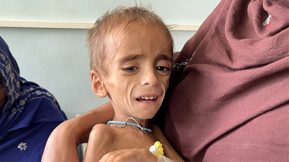 Afganistan\'da sağlık krizi: Açlık sınırındaki bebekleri tedavi eden doktorlar anlatıyor
