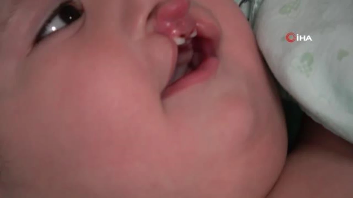 Yarık damak ve dudaklı bebeğe \'Türk lalesi\' ameliyatı