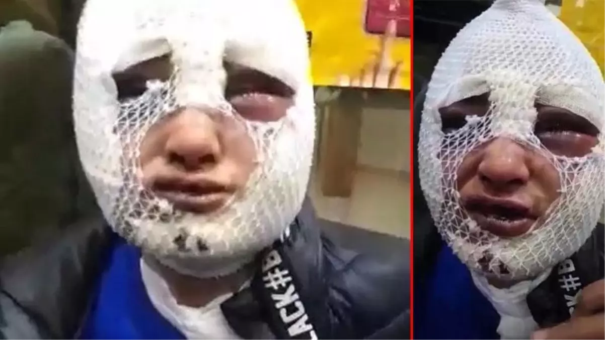 Eski sözlüsünün saldırısına uğrayan genç kadın yaşadığı dehşeti anlattı: Hap içirdi, ellerimi bağladı, üzerime kızgın yağ döktü