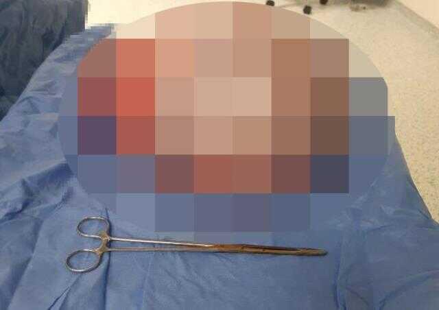 Karnından çıkana doktorlar bile inanamadı! 64 kilo girdiği ameliyattan 55 kilo çıktı Karnından çıkana doktorlar bile inanamadı! 64 kilo girdiği ameliyattan 55 kilo çıktı