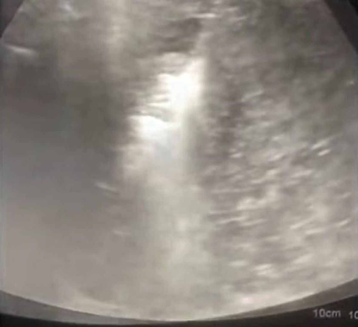 Karaciğerdeki tümör 10 dakikada yok edildi