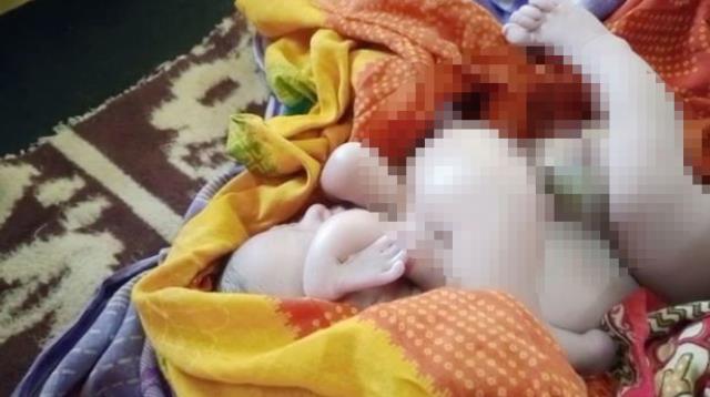 Doktor, doğumhanenin kapılarını kapatıp polisi aradı! Dört kollu ve dört bacaklı bebek infial yarattı