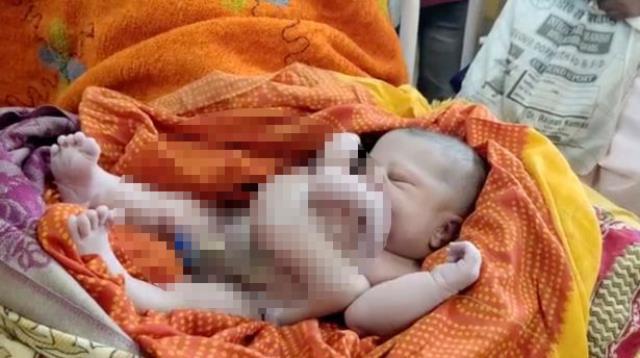 Doktor, doğumhanenin kapılarını kapatıp polisi aradı! Dört kollu ve dört bacaklı bebek infial yarattı