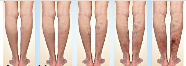 Uzmanından varisli anne adaylarına uyarı: Tedavi olmayın, bebeğe zarar verebilirsiniz