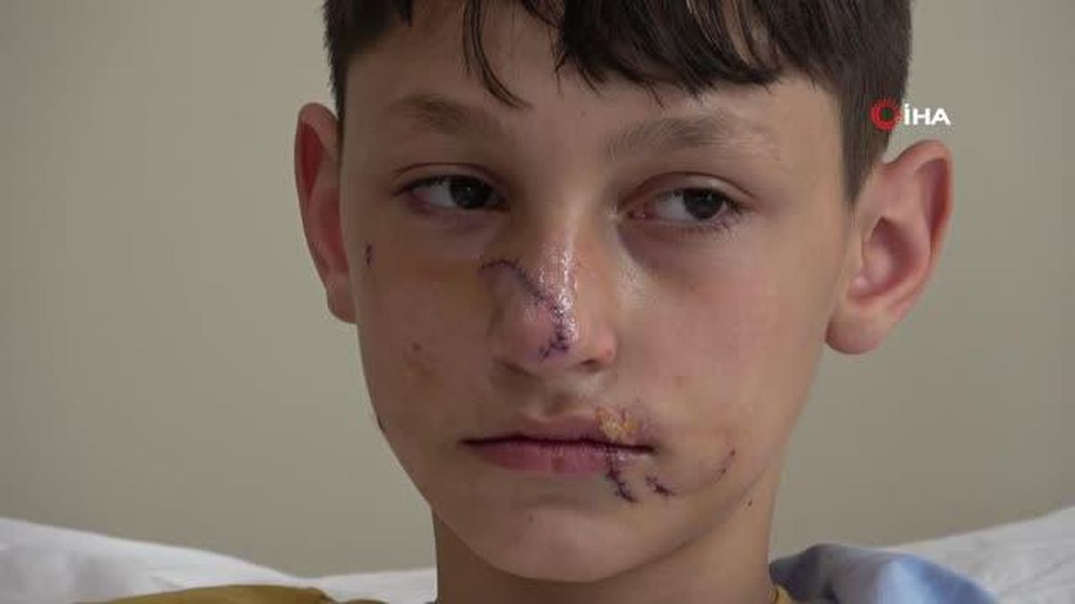 Minik Asiye gibi, köpek saldırısında yüzünden yaralanan Berat'tan sevindiren haber