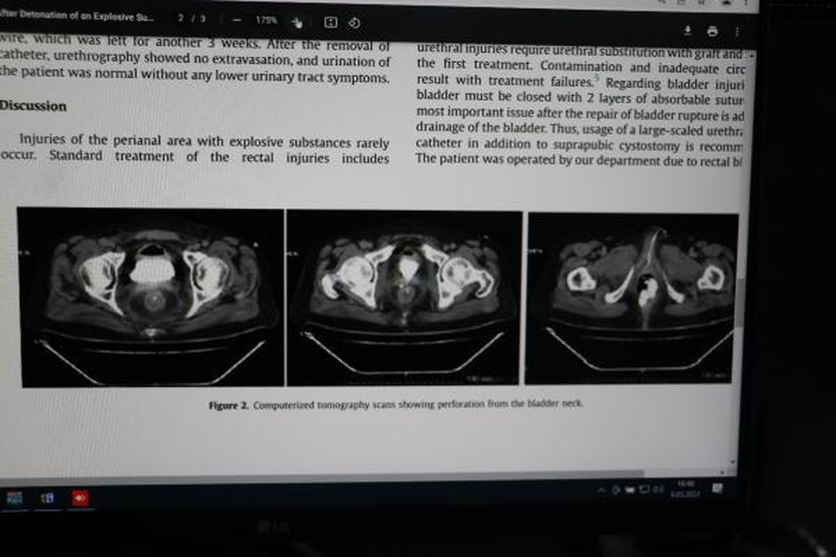 Makatına torpil yerleştirip patlatan kişi, tıp literatürüne girdi