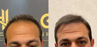 Saç Ekimi Nedir? World of the Hair Clinic