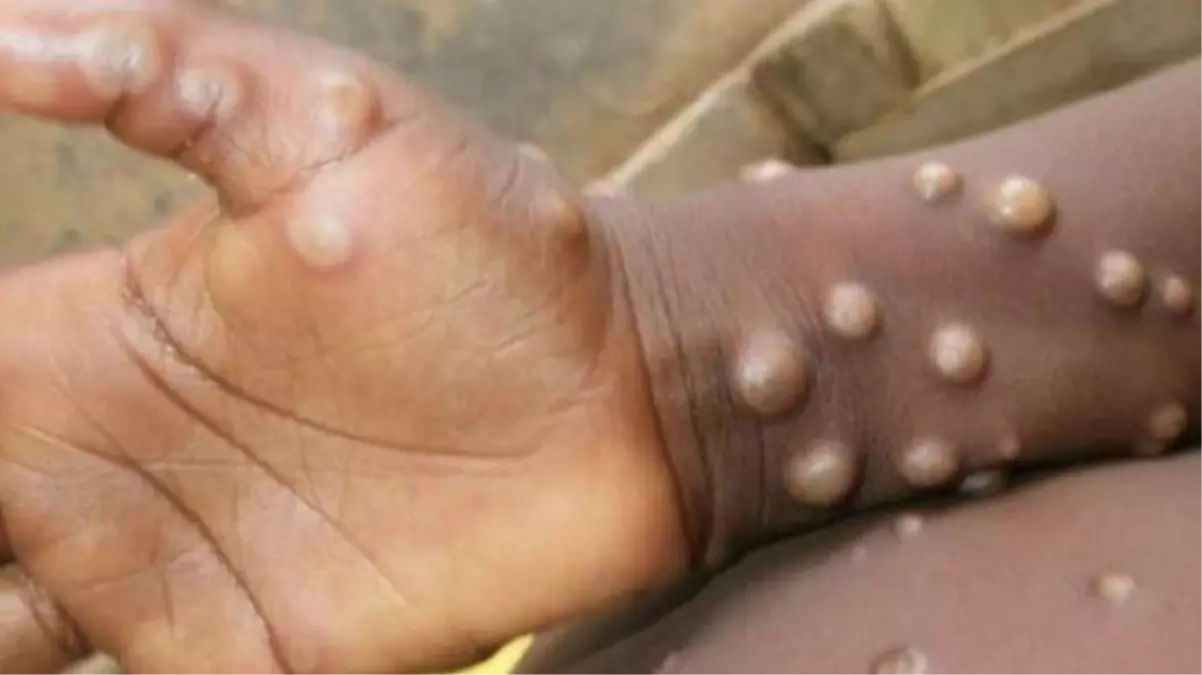 Maymun çiçeği virüsü yedi ülkenin ardından Belçika\'da da ortaya çıktı