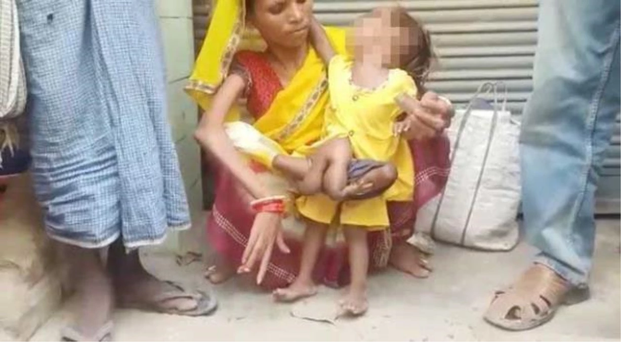 Görenler hayrete düştü! Hindistan\'da bir bebek 6 bacaklı doğdu