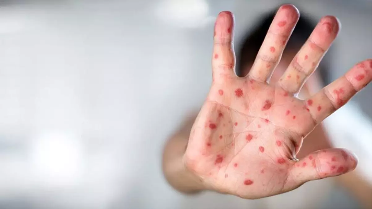 Norveç\'te yurt dışından gelen bir erkekte maymun çiçeği virüsü tespit edildi