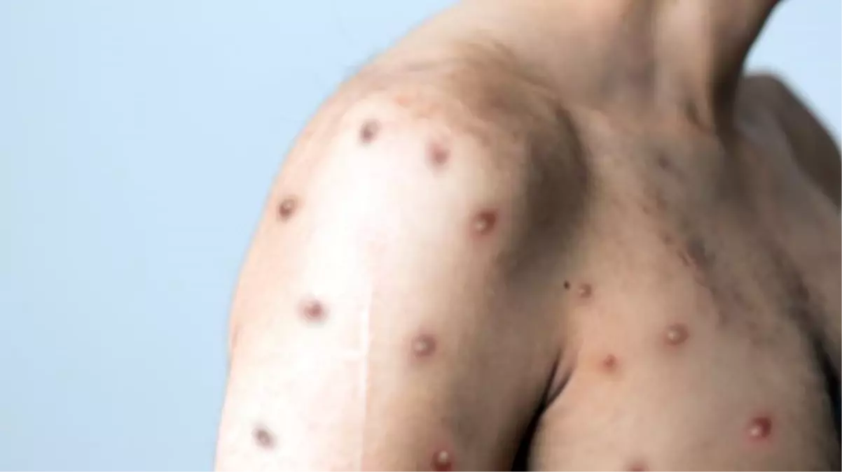 Maymun çiçeği virüsüne ilk yasak haberi Nijerya\'dan geldi: Vahşi hayvan eti satışı yasaklandı