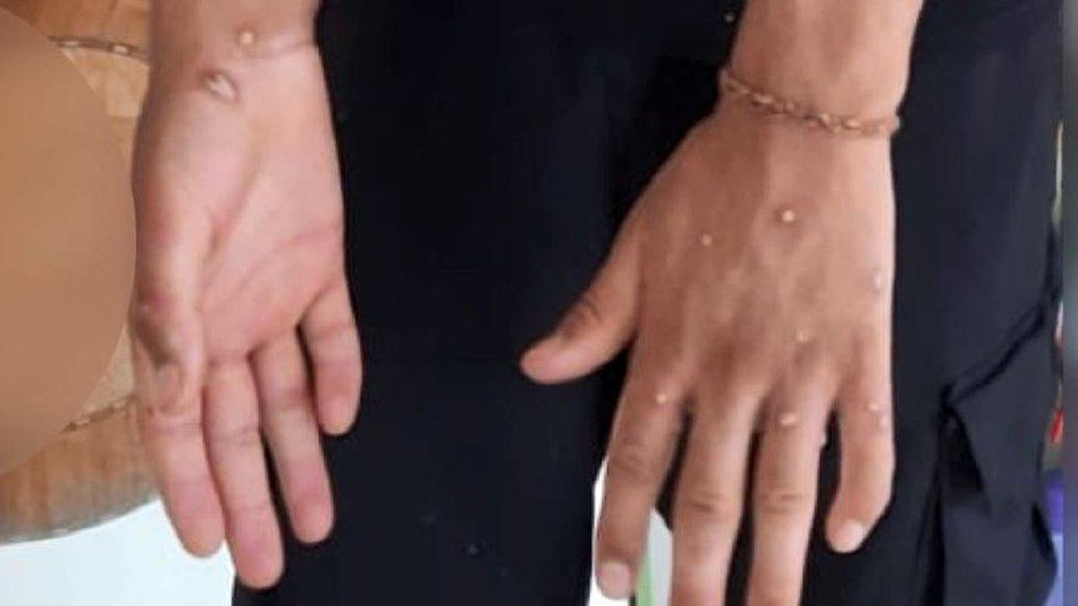 Maymun çiçeği virüsü: İstanbul\'da üç kişi karantinaya alındı