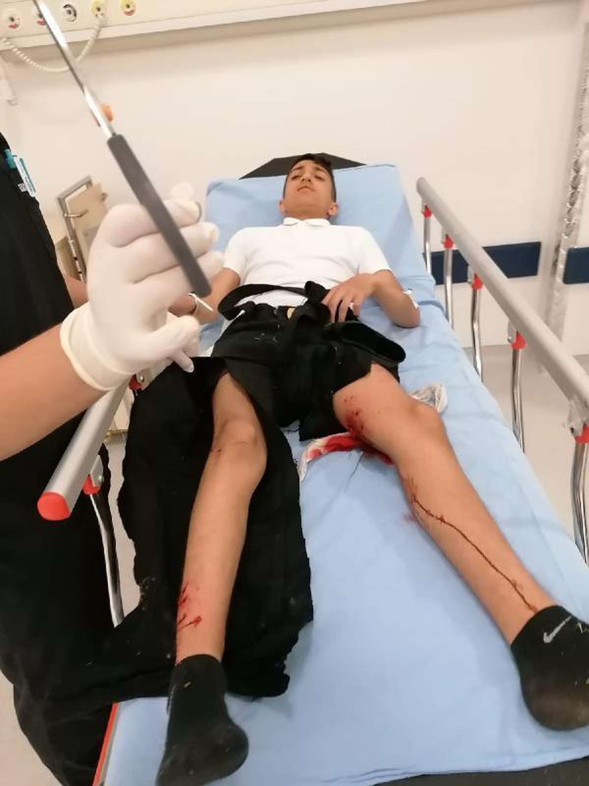Okulun önünde köpeklerin saldırdığı liseli Efe, yaralandı