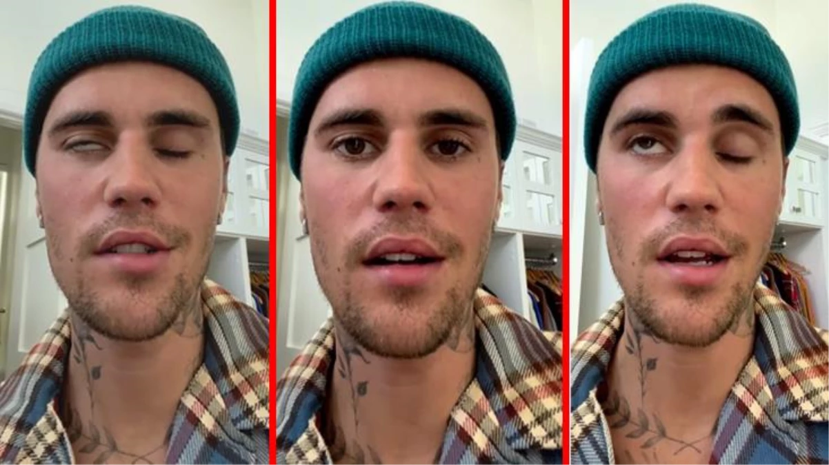 Justin Bieber yüz felci geçirdi! Sadece bir gözünü oynatabiliyor