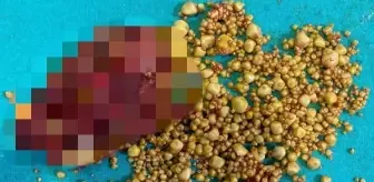 Safra kesesinden 1284 taş çıktı