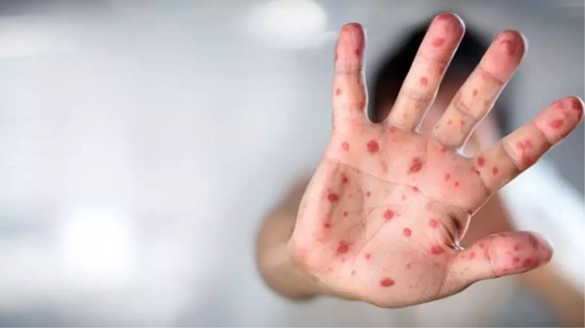 Maymun çiçeği virüsü Türkiye\'ye yaklaştı! Gürcistan\'da da ilk vaka görüldü