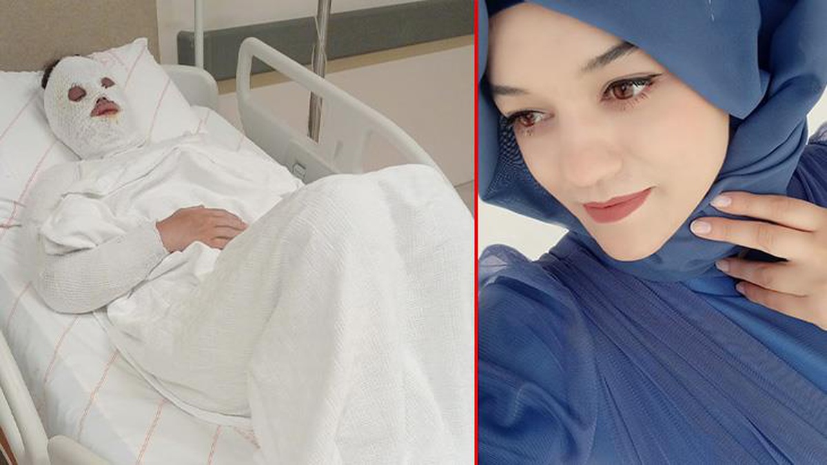Korkunç olay! 1,5 yıl önce ayrıldığı nişanlısının yüzüne yanıcı madde attı