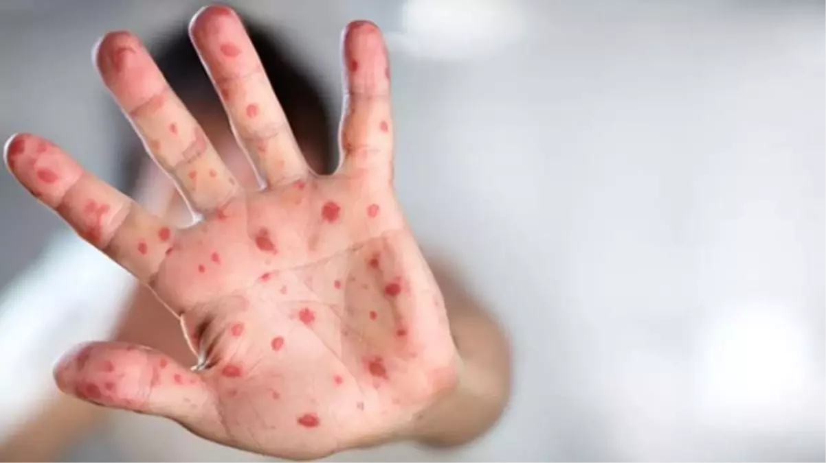 Maymun çiçeği virüsü Türkiye\'nin etrafını sarmaya başladı! Bulgaristan\'da da görüldü