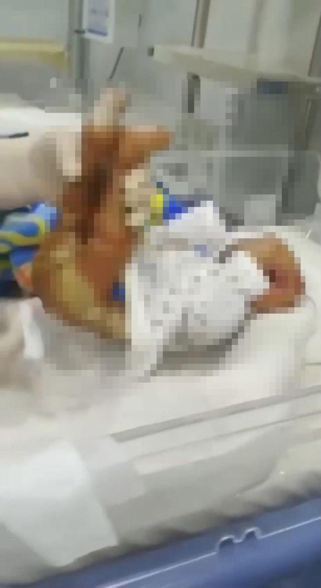 Kalıtımsal hastalıkla doğan bebek hastaneyi alarma geçirdi, yüzünü gören doktorlar dehşete kapıldı