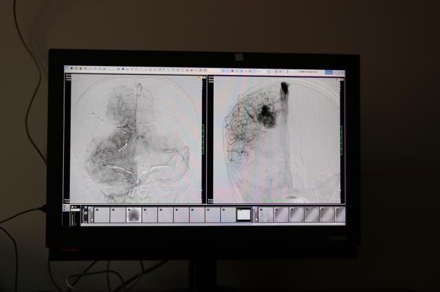 Beyninde damar yumağı oluşan çocuk, 20 saatlik ameliyatla hayata tutundu