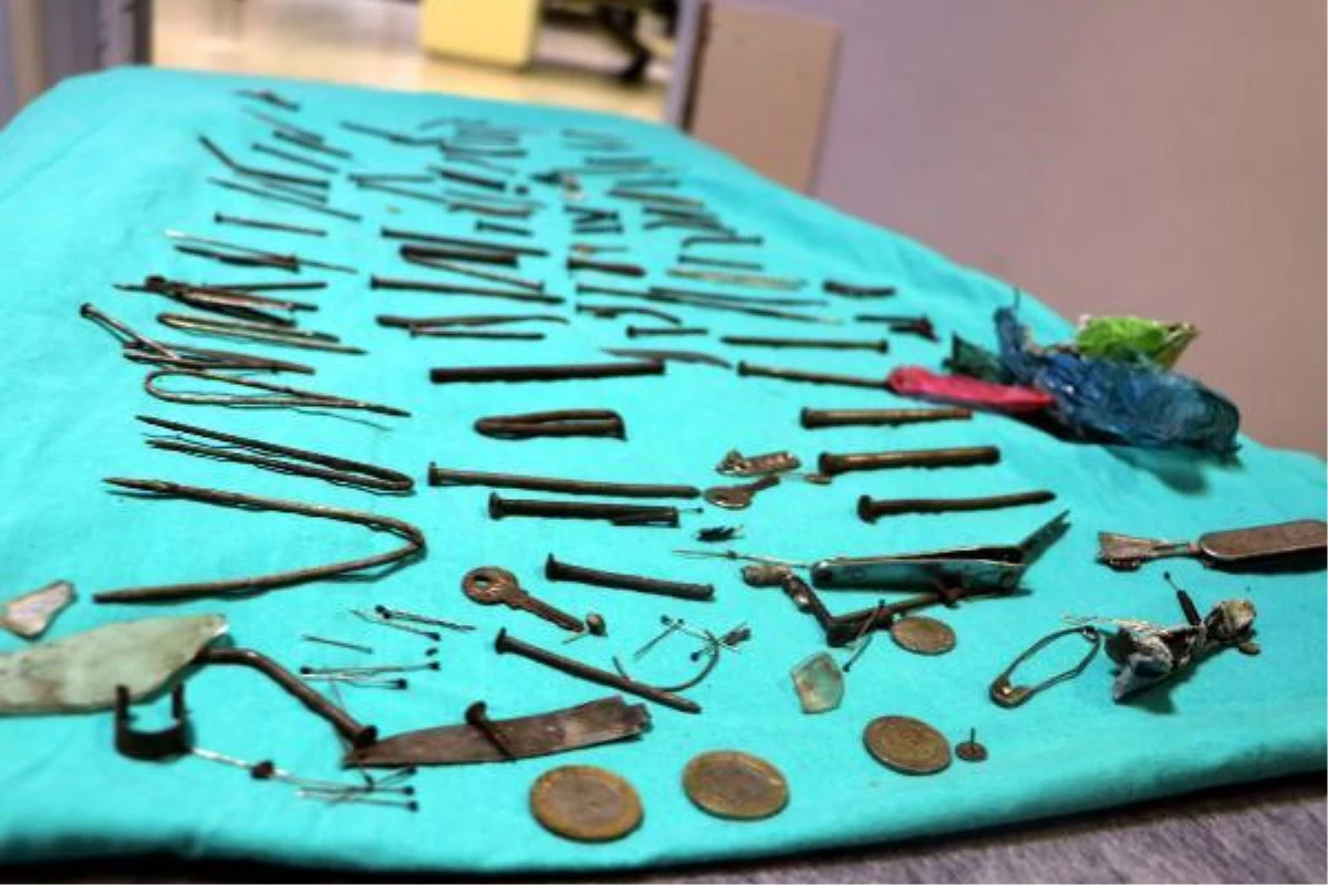 Nails, knives, tweezers: 158 pieces of metal were removed from the stomach of a woman