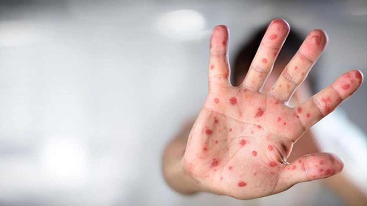 Yeni salgın! DSÖ, şu ana kadar 5 ölüme neden olan maymun çiçeği için küresel acil durum ilan etti