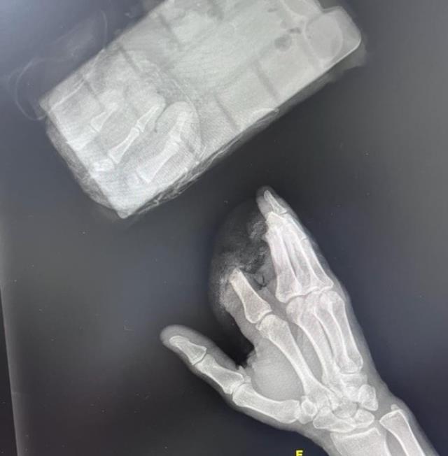 Kopan 3 parmağını poşete koydu hastaneye koştu, ameliyatla sağlığına kavuştu