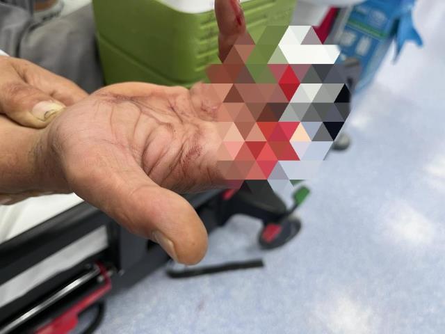 Kopan 3 parmağını poşete koydu hastaneye koştu, ameliyatla sağlığına kavuştu