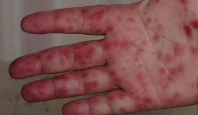 Eyvah eyvah! Başımıza şimdi de domates gribi çıktı, işte ilk belirtileri