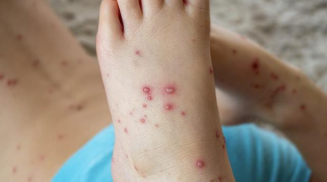 Korona ve maymun çiçeği bitmeden bu kez de domates gribi patlak verdi! Bu 5 belirtiye dikkat