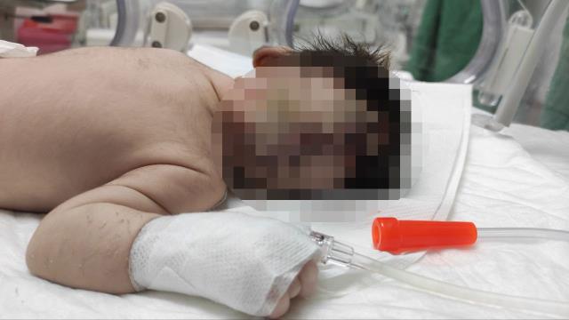 Kahramanmaraş'ta beyni kafatasından dışarıda olan bebek doğdu Kahramanmaraş'ta beyni kafatasından dışarıda olan bebek doğdu