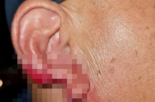 Sarhoş eskort, öpme bahanesiyle yaklaştığı adamın kulağını koparıp yuttu