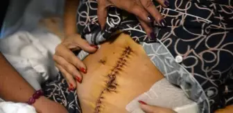 Eski sevgili dehşeti; midesinin yüzde 30'u alındı, vücuduna 135 dikiş atıldı