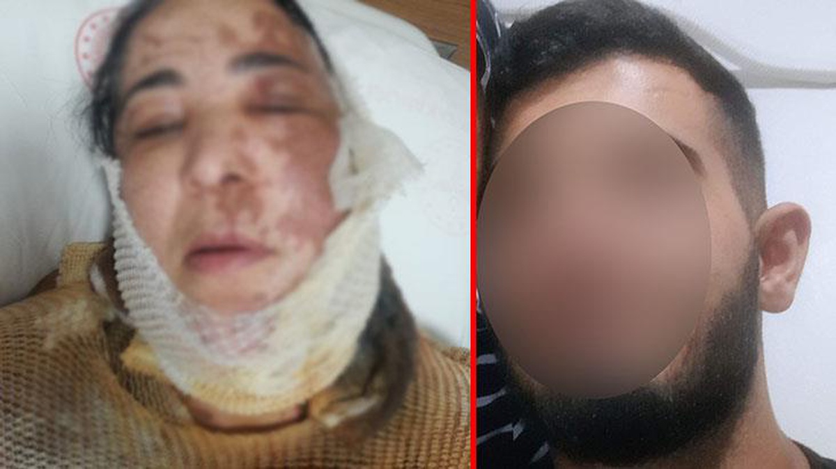 Adana\'da korkunç olay! 21 yaşındaki genç üvey annesinin üzerine kezzap döktü