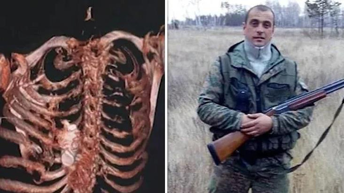Rus askerin göğüs kafesine patlamamış el bombası sıkıştı! Doktorlar koruyucu kıyafet giyerek ameliyata girdi