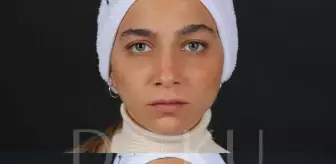 Doku Medical - Dudak Dolgusu ve Burun Dolgusu Uygulamaları Ameliyat Gerektirir Mi?