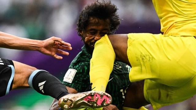 Arjantin maçında yüzü adeta dağılmıştı! Suudi futbolcu hastaneden son halini paylaştı Arjantin maçında yüzü adeta dağılmıştı! Suudi futbolcu hastaneden son halini paylaştı