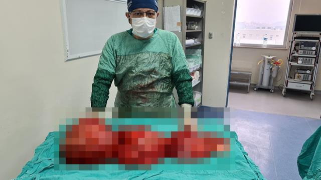 Tokat'ta kilo aldığını sanan damın karnından 13 kilo kitle çıkartıldı Tokat'ta kilo aldığını sanan damın karnından 13 kilo kitle çıkartıldı