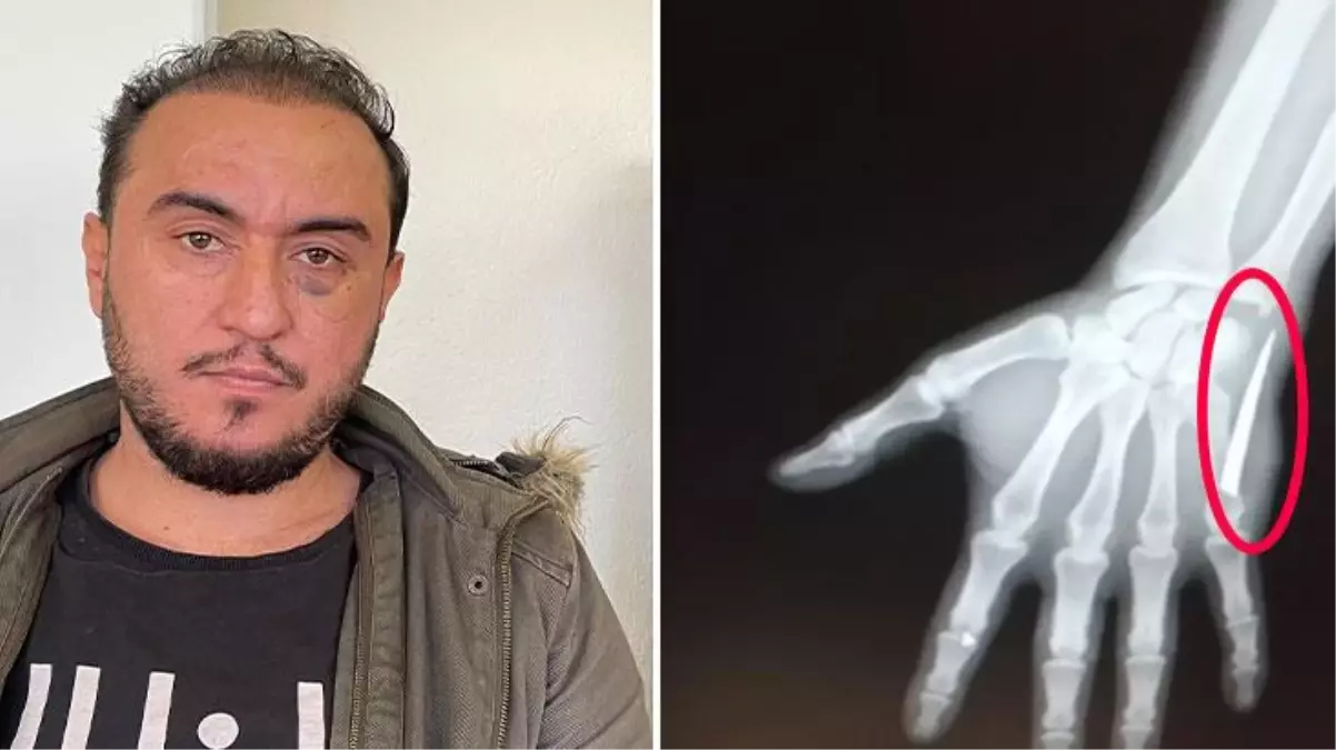 Elinde 2 aydan bu yana devam eden ağrı sebebiyle hastaneye giden vatandaş, röntgen sonucunu görünce hayatının şokunu yaşadı