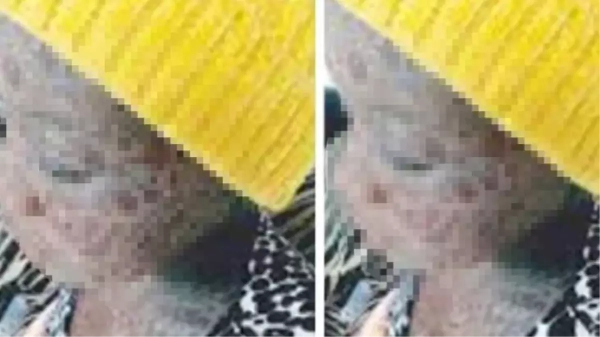 Artık vücudu tedavilere yanıt vermiyor! 17 yaşındaki Zimbabweli kız, yaşadığı cilt hastalığı sebebiyle büyük acılar çekiyor