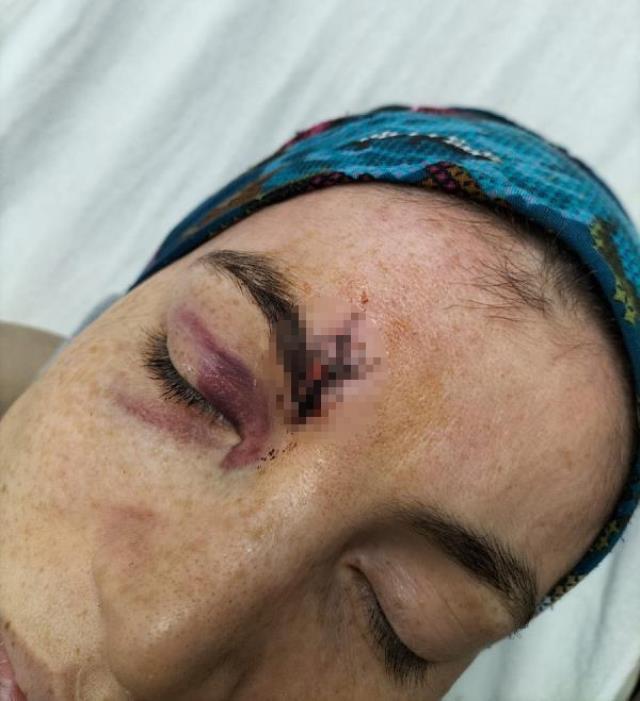 Cinsel ilişki teklifini reddedince eşinin dövdüğü kadın, korumaya alındı
