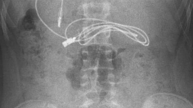 Mide bulantısı şikayetiyle hastaneye giden çocuğun midesinden 1 metrelik şarj kablosu çıktı