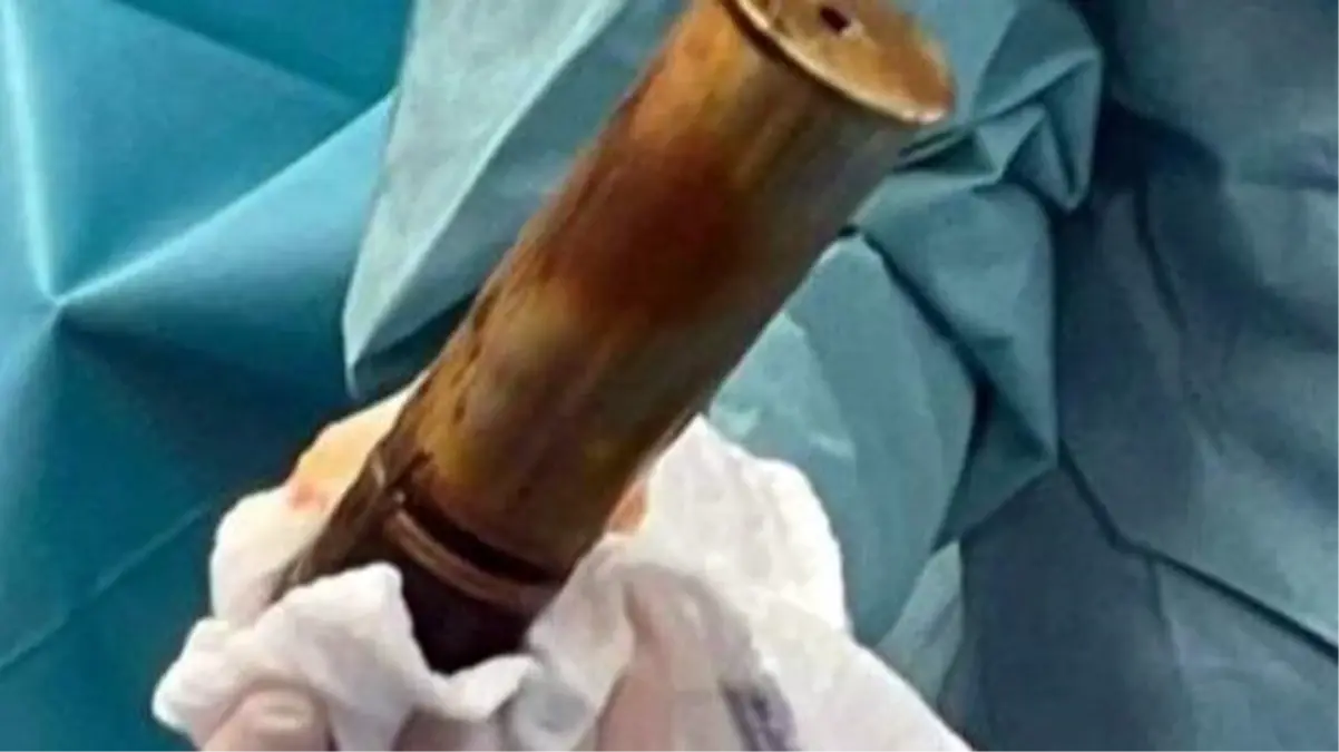 Bir garip olay! Anüsüne top mermisi sıkışan yaşlı adam hastanede herkesi şaşkına çevirdi