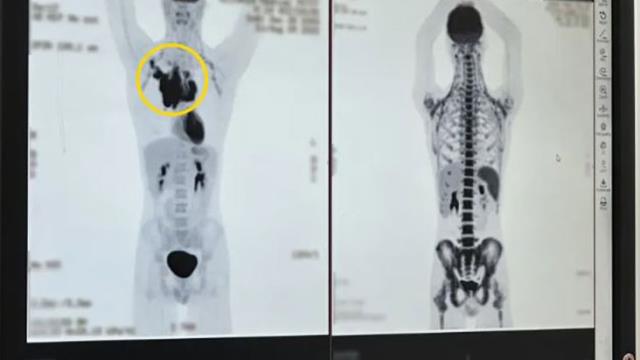 Omzundan 'Tık' diye ses duyan genç, hastanede gittiğinde kanser olduğunu öğrendi Omzundan 'Tık' diye ses duyan genç, hastanede gittiğinde kanser olduğunu öğrendi