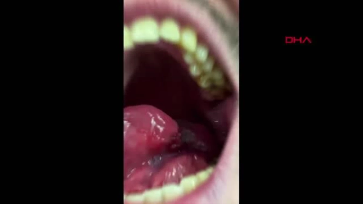 Çürük dişini önemsemeyen genç adam hızla yayılan dil kanserine yakalandı