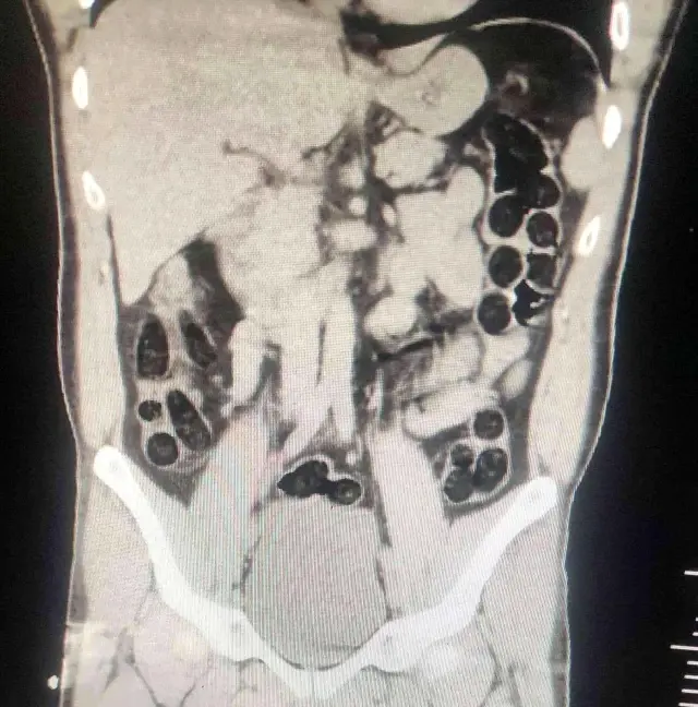 İhbar üzerine durdurulan otobüsteki yolcunun midesinden 76 paket uyuşturucu madde çıktı