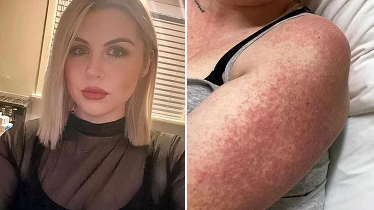 İngiltere'de ilginç olay! Vücudunda yanıklar oluşan genç kadını kullandığı ilaçlar bu hale getirmiş
