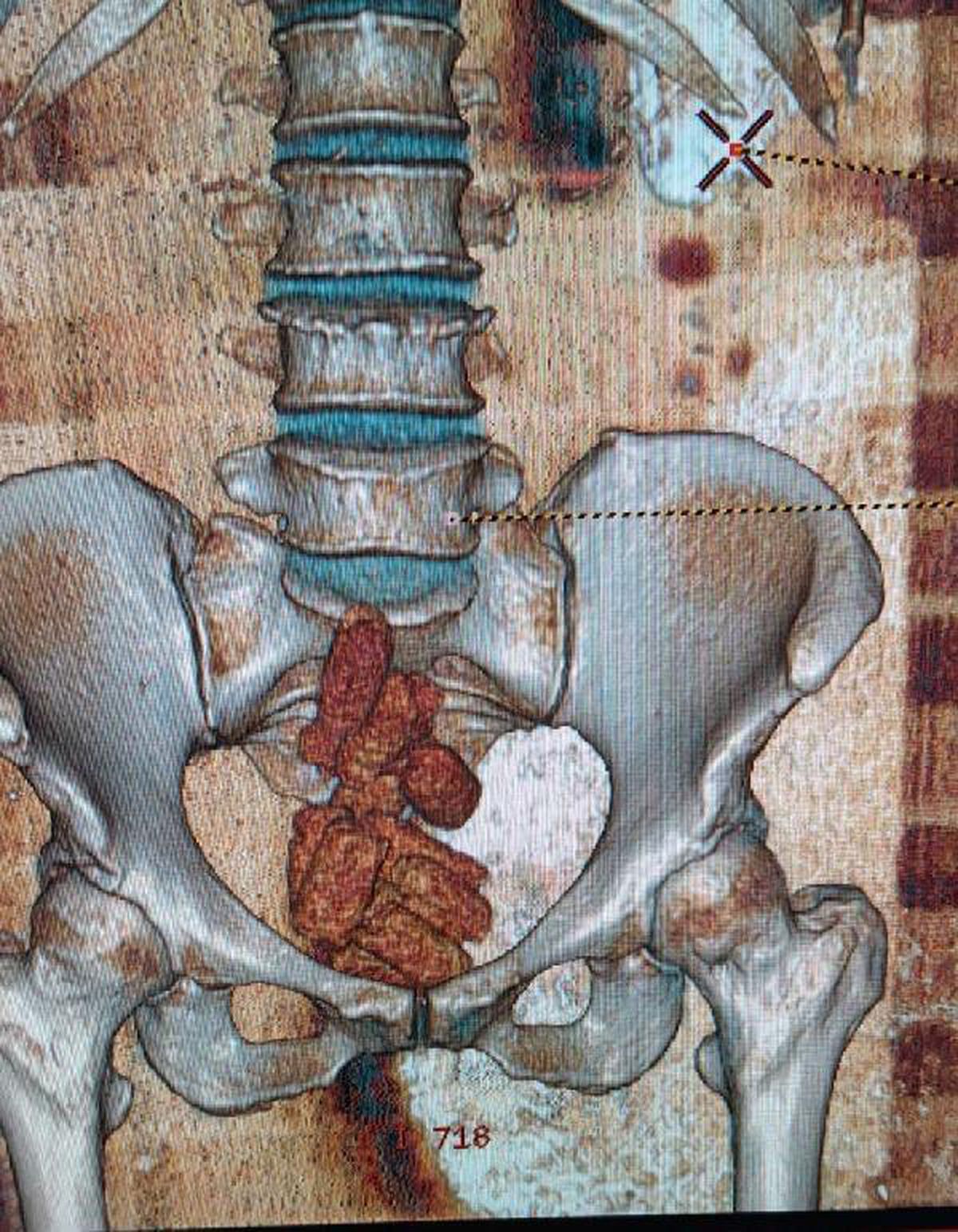 Bağırsaklarındaki uyuşturucu tomografiyle ortaya çıktı
