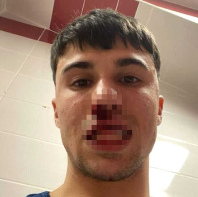 Sivasspor-Fiorentina maçında kan aktı! Sahaya atlayan taraftar İtalyan futbolcunun burnunu kırdı